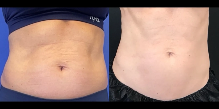 Before and After photo of an Emsculpt Neo patient from The Hughes Center in Cherry Hill NJ