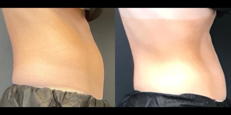 Before and After photo of an Emsculpt Neo patient from The Hughes Center in Cherry Hill NJ