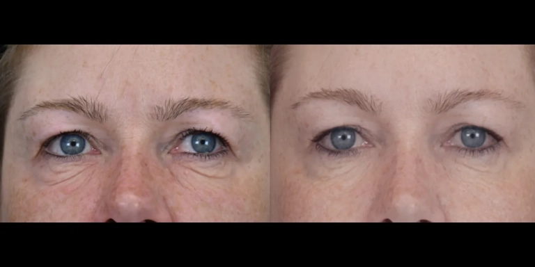 Before and After photo of an Exion patient from The Hughes Center in Cherry Hill NJ