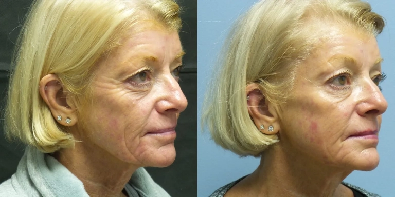 Before and After photo of Genius RF treatment at The Hughes Center in Cherry Hill NJ