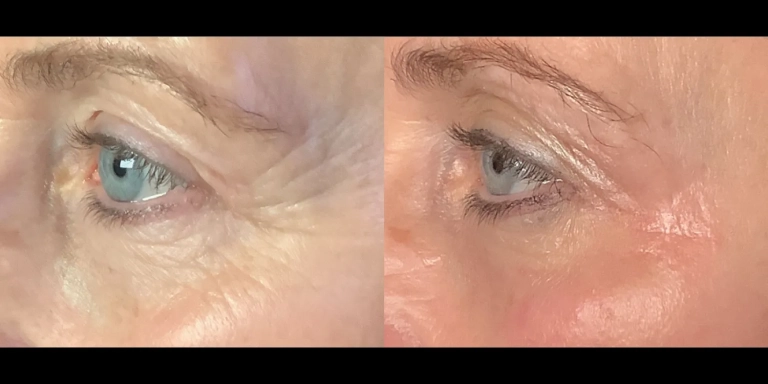 Before and After photo of an Opus Plasma patient from The Hughes Center in Cherry Hill NJ