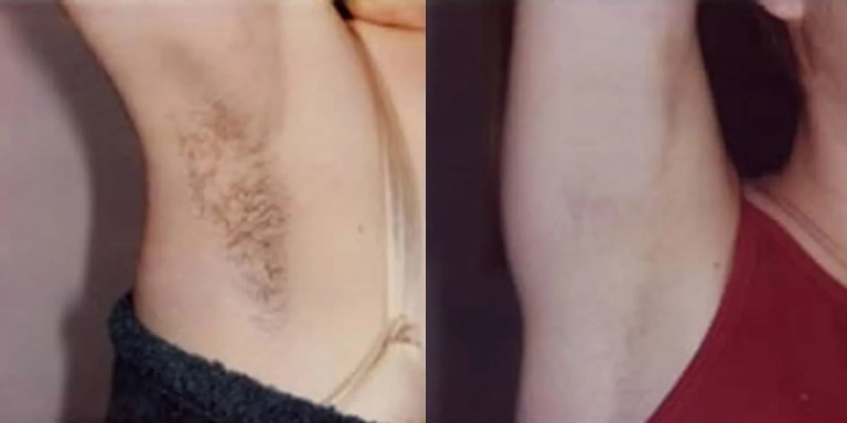 Before & After photo for Laser Hair Removal at The Hughes Center in Cherry Hill NJ